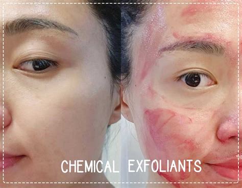 Aha Vs Bha All You Need To Know About Chemical Exfoliants The Everyday Blogger