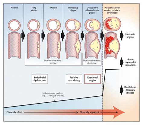 The goal of treatment is to prevent the development of angina pectoris and possibly also to improve the prognosis. Chronic Stable Angina | NEJM
