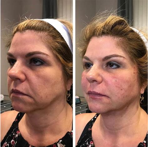 Non Surgical Facelift Non Invasive Lift Jacksonville Beach Pure