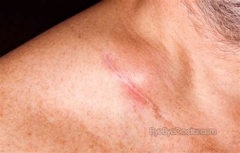 Swollen Lymph Nodes In Armpit Hiv Images Galleries