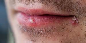 If You Get Cold Sores Can You Give Your Sexual Partner Genital Herpes