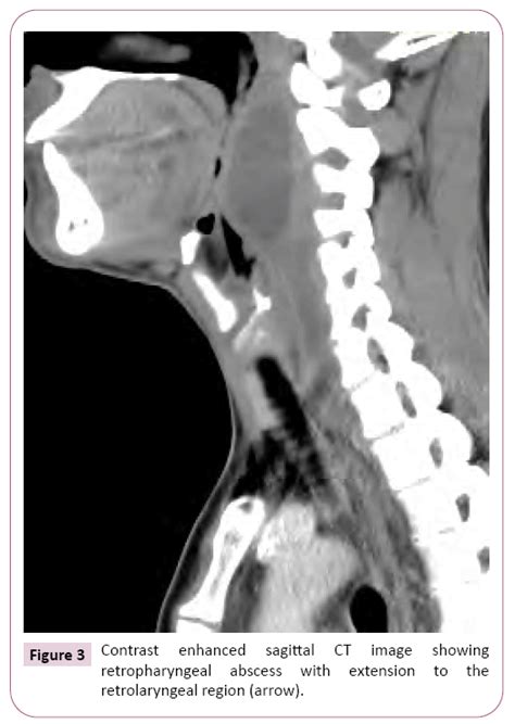 Primary Tuberculous Retropharyngeal Abscess