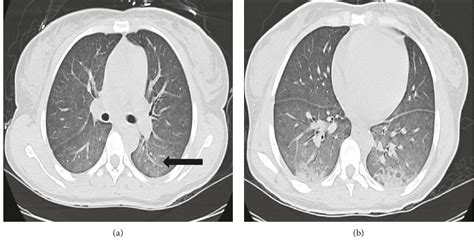 Figure 2 From Pulmonary Toxoplasmosis Diagnosed On Transbronchial Lung