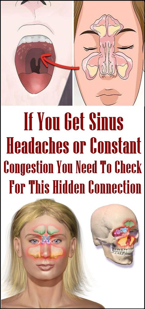 If You Get Sinus Headaches Or Constant Congestion You Need To Check For