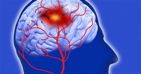 Las 5 diferencias entre accidente cerebrovascular isquémico y hemorrágico