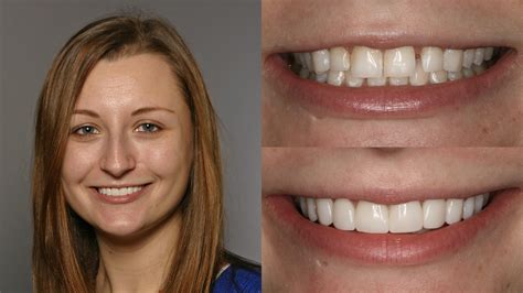 Before After Composite Veneers Treatment 8