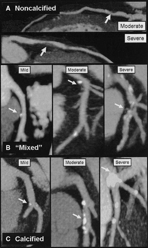 Role Of Computed Tomography For Diagnosis And Risk Stratification Of