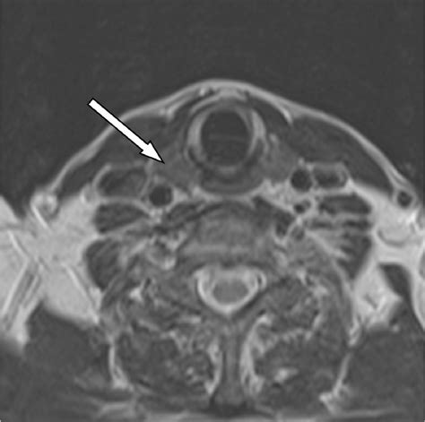 Diagnostic Imaging Of The Thyroid Gland Ct And Mri Features