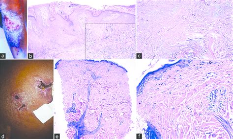 Case 2 A‑c A Hyperkeratotic Plaque With Central Ulceration On The