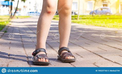 The Wound On The Child`s Leg Fell On The Road Broken Knee Health