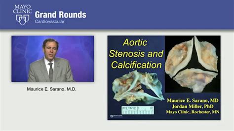 Grand Rounds Aortic Stenosis And Calcification Mayo Clinic