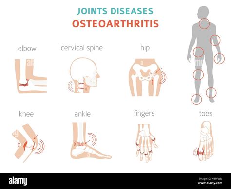 Arthritis Osteoarthritis Medical Infographic Design Joint Replacement Implantant Vector