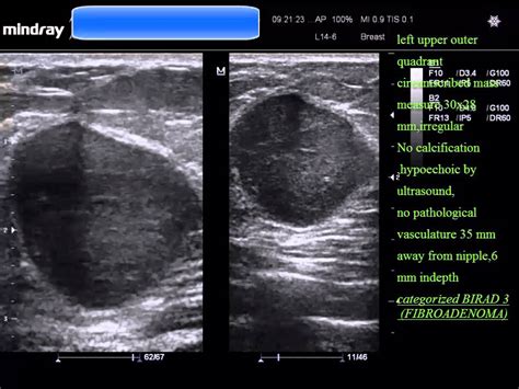 Case 104 Sonomammography Fibroadenoma Youtube
