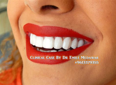 Teeth Whitening Dr Emile Medawar 00961 3 379355 احصل على ابتسامة مُتناسقة جميلة في عيادة طب