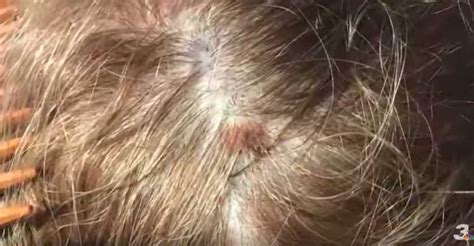 Womans Hairstylist Noticed A Deadly Mole On Clients Scalp