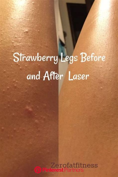 Strawberry Legs Before And After Laser Exfoliatingscrub In 2020