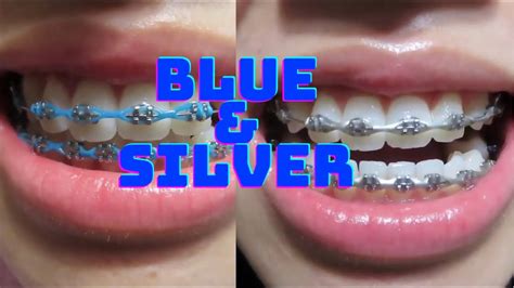 10th Braces Update Blue To Silver Color Youtube