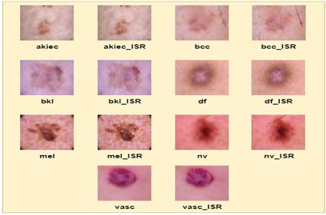 Applied Sciences Free Full Text Skin Cancer Classification