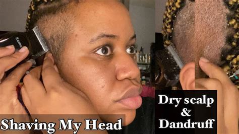 shaving my head struggling with dry scalp and dandruff youtube