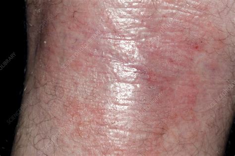 Atopic Eczema Behind The Knee Stock Image C0167249 Science Photo