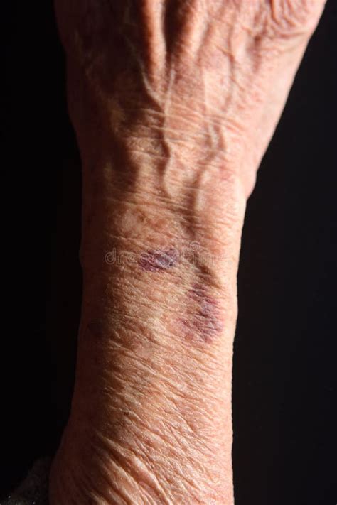 Close Up Of A Bruise In The Arm Of Senior Woman Stock Image Image Of