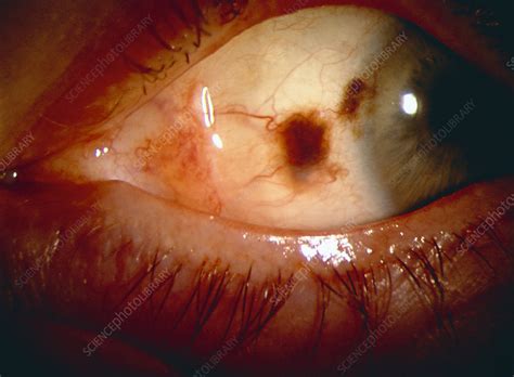 Eye Cancer Stock Image M1310733 Science Photo Library