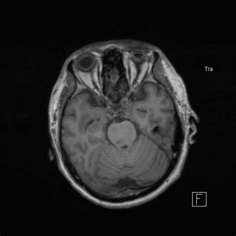 Cerebral Abscess Radiology Case