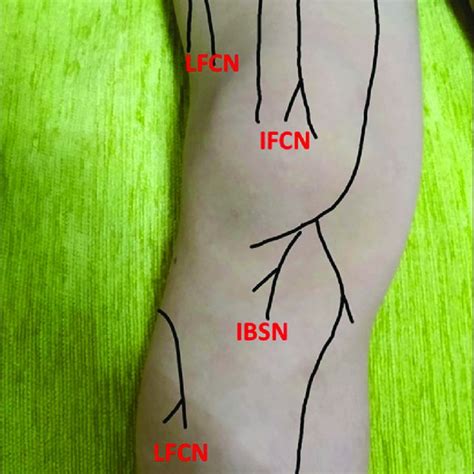 Tender Chronic Constrictive Injury Cci Points Lfcn Lateral Femoral