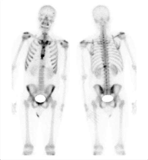 Whole Body Bone Scan Displaying Increased Uptake Of The Left