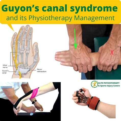 Guyons Canal Syndrome And Its Management Elite Physiotherapy