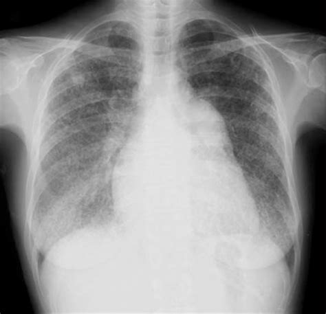 Chest X Ray Cardiomyopathy