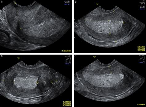 Uterine Cancer Ultrasound Endometrial Hyperplasia My Xxx Hot Girl