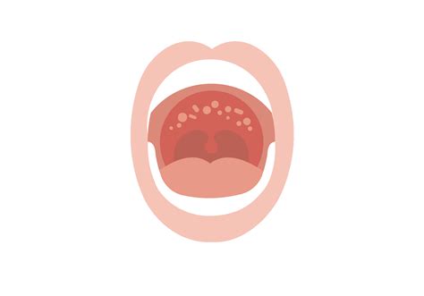 Swollen Lymph Nodes In Mouth