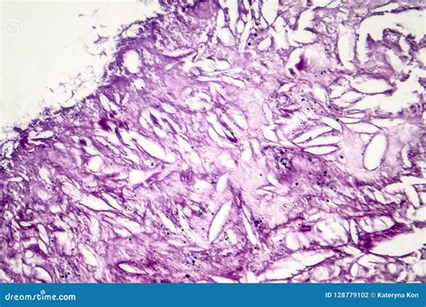 Histopathology Of Melanoma Granules Look Like Ihc Slides Royalty Free
