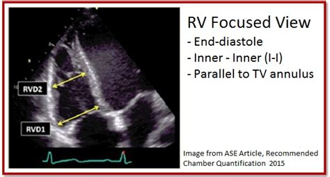 7 Tips To Implementing Right Ventricle Quantification Cardioserv