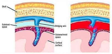 The Mechanism Of Subdural Haemorrhage The Bridging Veins Travel From