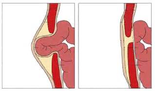 Check with your doctor sounds like it could be an inguinal hernia, and it maybe the bowel is pushing to * the area while you are walking or gravity is pulling area down. What is a Hernia? - Definition & Types | Study.com