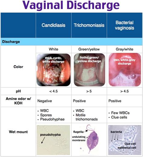 Candida Vaginitis Discharge