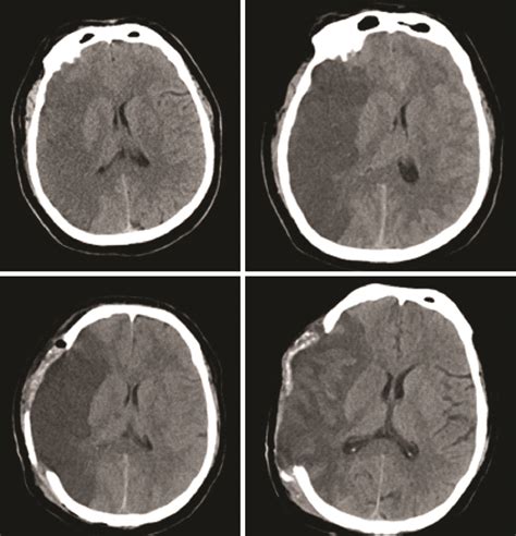 Corona Acute Ischemic Stroke Malignant Cerebral Edema And Hemo