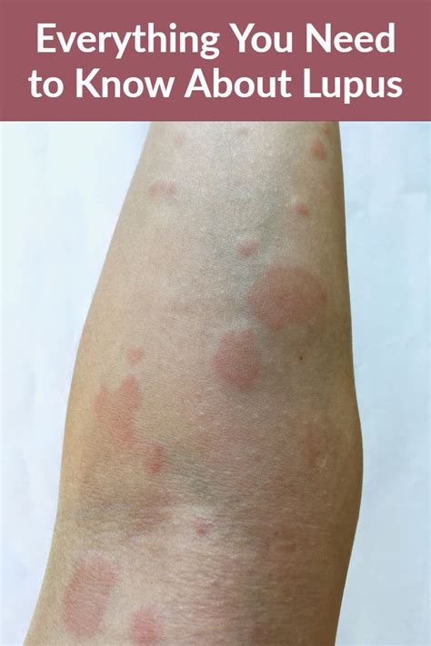 The Best 12 Lupus Skin Lesions On Legs Sravenewall