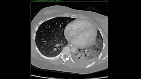 Obstructive Retrosternal Goitre Mimicking Severe Bronchial Asthma In