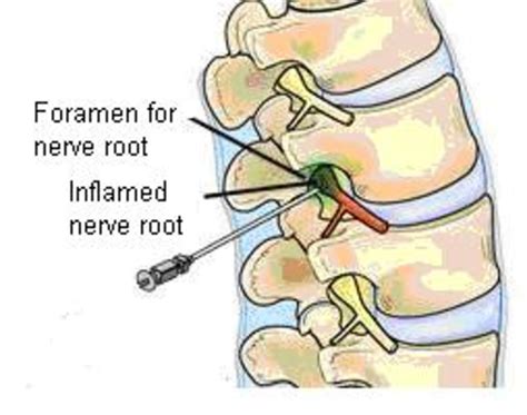 Epidural Nerve Root Block Injection A Personal Experience Hubpages