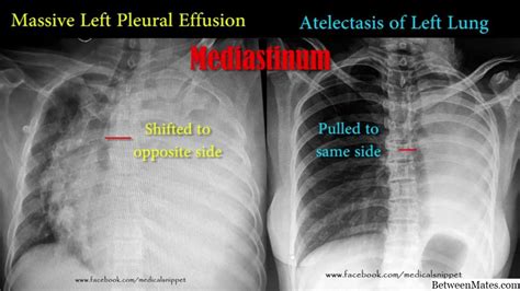 Pulmonary Edema Vs Pleural Effusion X Ray Sexiz Pix