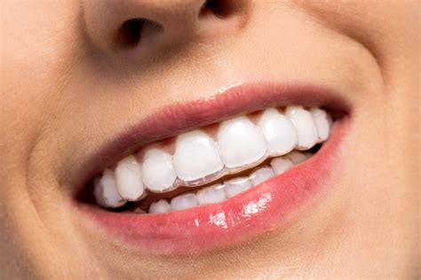 Straight Teeth With Invisalign In Virginia Beach Va Hampton Roads