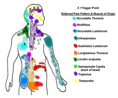 Trapezius Trigger Points Referred Pain