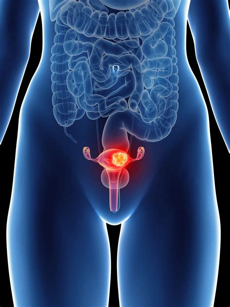 Endometrial Cancer American Institute For Cancer Research