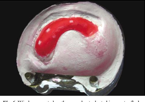 Figure 6 From A Hollow Definitive Obturator Fabrication Technique For