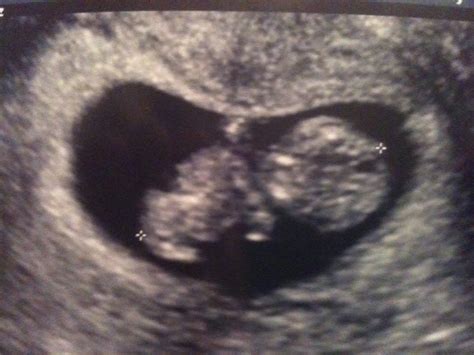 Bumpy Road To Motherhood Pics Of 10 Week Ultrasound
