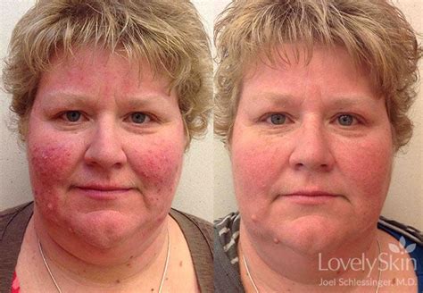 Rosacea Laser Treatment Before And After
