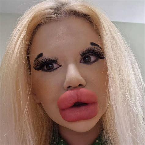 Young Woman Has 27 Procedures To Get The Biggest Lips In The World
